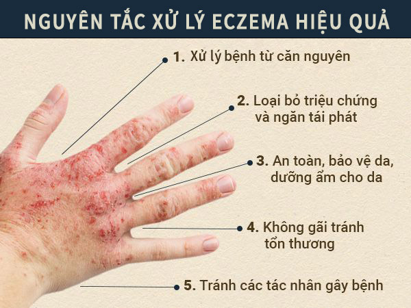 Nguyên tắc xử lý bệnh eczema hiệu quả, an toàn
