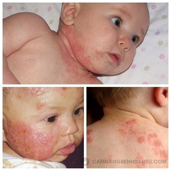 Một số hình ảnh bệnh chàm ở trẻ em