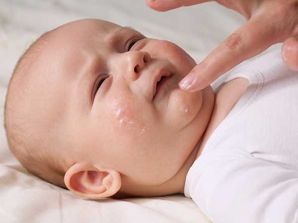 Bôi thuốc trị viêm da ở trẻ sơ sinh lên vị trí da bị tổn thương