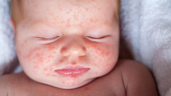 Viêm là ở trẻ sơ sinh là tình trạng bệnh lý về da rất phổ biến