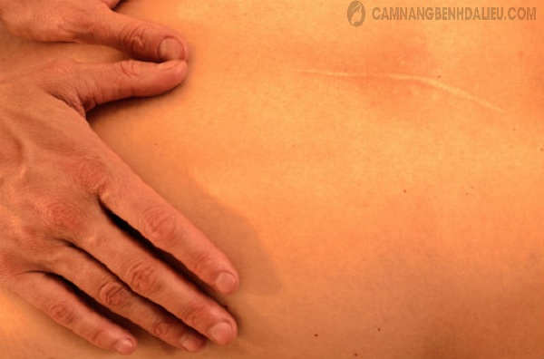 Massage là cách trị sẹo rỗ, sẹo lồi bằng phương pháp tự nhiên hiệu quả