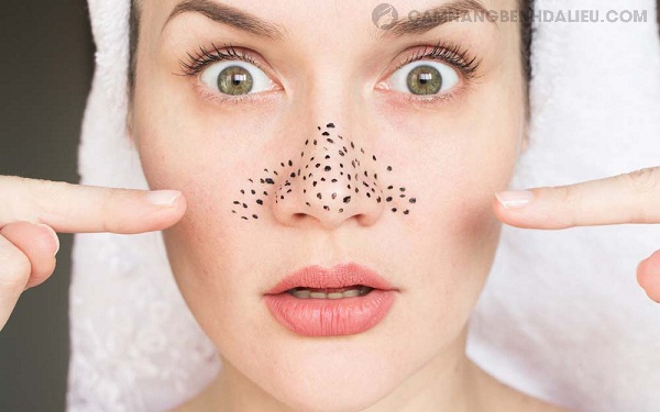 Dùng mặt nạ, miếng dán hoặc xông hơi giúp lấy mụn đầu đen nhưng không trị triệt để