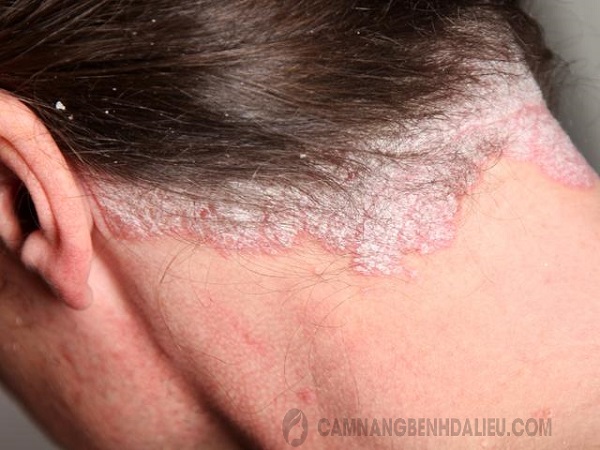 Bệnh á sừng da đầu ảnh hưởng rất lớn đến sinh hoạt và cuộc sống của người bệnh