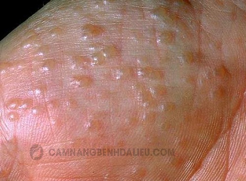 bệnh eczema