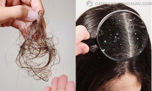 Nấm da đầu mãn tính gây rụng tóc, bong tróc da đầu thì có thể chữa được bằng bài thuốc gia truyền Đỗ Minh Đường không?