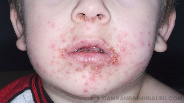 Chốc lở ngoài da xuất hiện trên mặt của một em bé