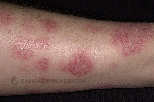 bệnh eczema