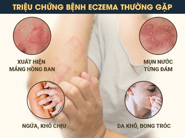 Triệu chứng bệnh eczema