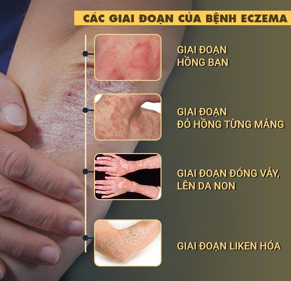 4 giai đoạn của bệnh eczema