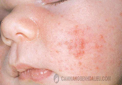 bệnh eczema tiếp xúc
