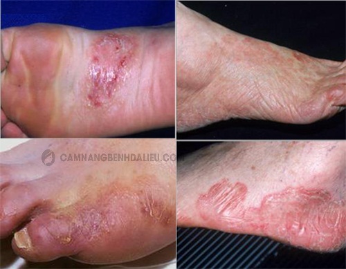 Bệnh Nấm da chân