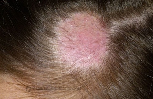 Hình ảnh bệnh Nấm da đầu