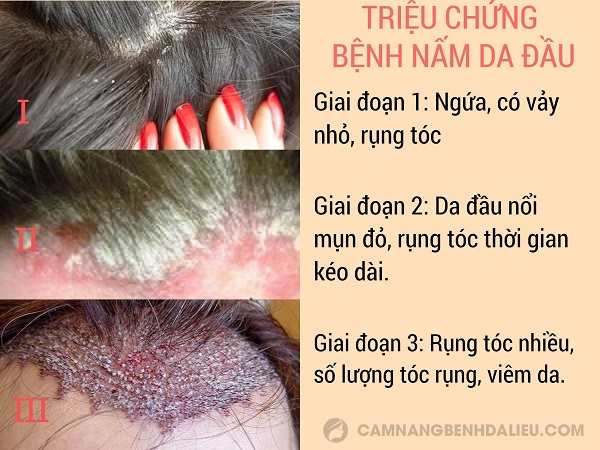 Triệu chứng bệnh nấm da đầu qua 3 giai đoạn phát triển bệnh