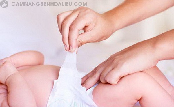 Trẻ dùng bỉm dễ bị nấm da ở mông