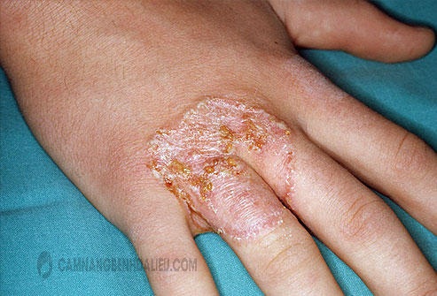 Bệnh Nấm da tay