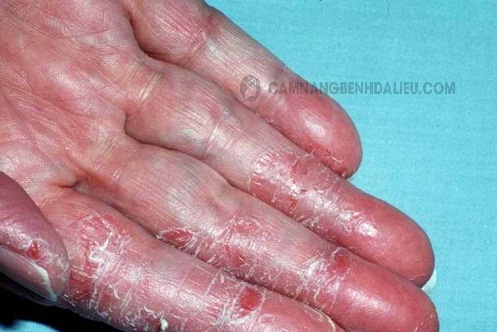 Bệnh Nấm bàn tay