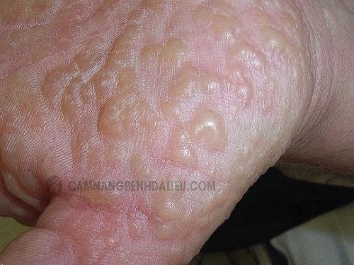 Hình ảnh về bệnh nấm tổ đỉa ở tay