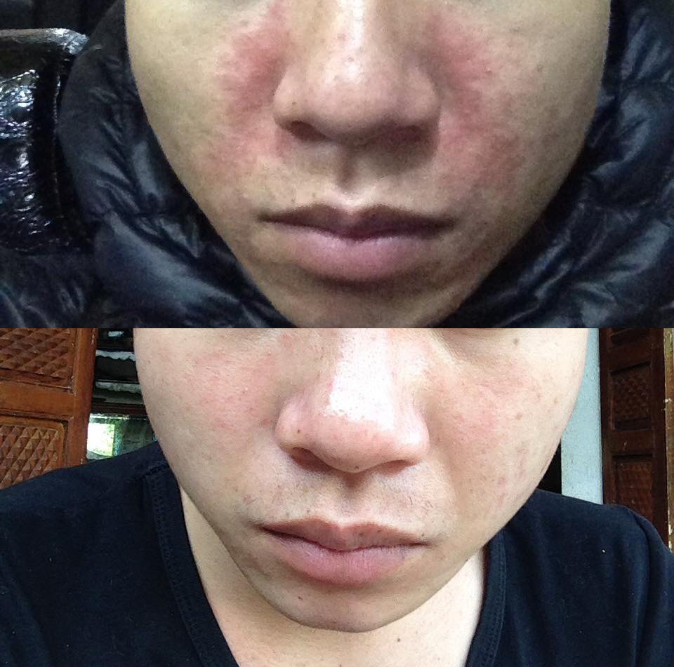 Hình ảnh bệnh nhân trước và sau khi sử dụng bài thuốc viêm da dầu