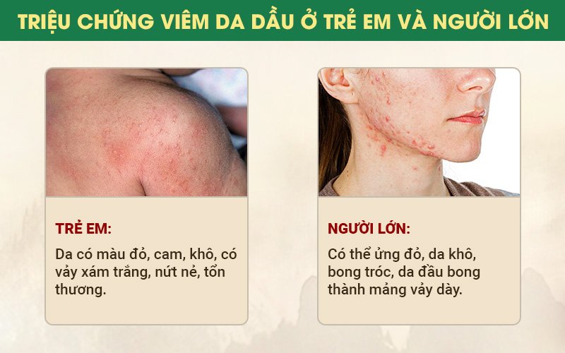 Viêm da dầu không phân biệt tuổi tác và đối tượng, ai cũng có thể bị bệnh viêm da dầu.