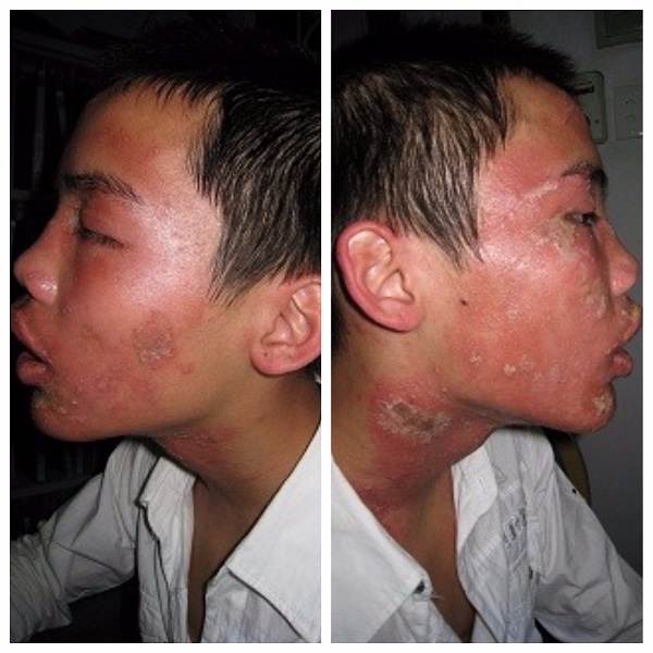 Bệnh nhân bị viêm da tiếp xúc do côn trùng ở mặt (ảnh Bệnh viện Da liễu Trung Ương).