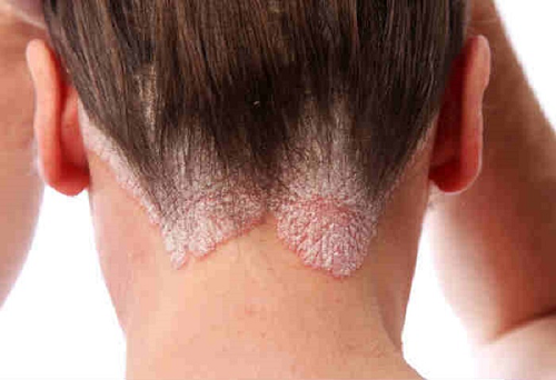 Nguyên nhân và triệu chứng gây viêm nang lông da đầu 