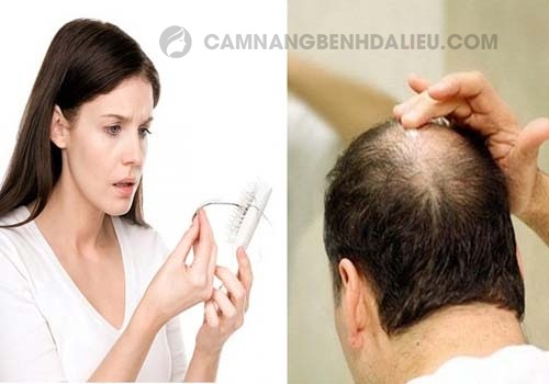 Bệnh viêm da đầu có triệu chứng gì?