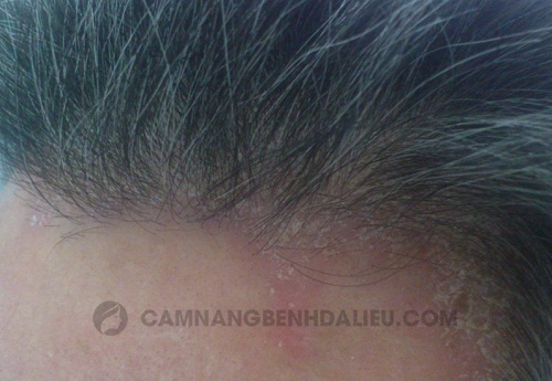 Dấu hiệu nhận biết bệnh viêm da đầu 
