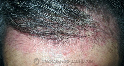 Cách điều trị vảy nến da đầu cho kết quả tốt, người bệnh nên thử - Cẩm nang bệnh da liễu