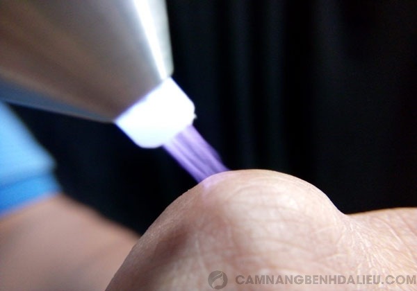 Cách chữa bệnh sùi mào gà ở nam giới bằng đốt tia laser