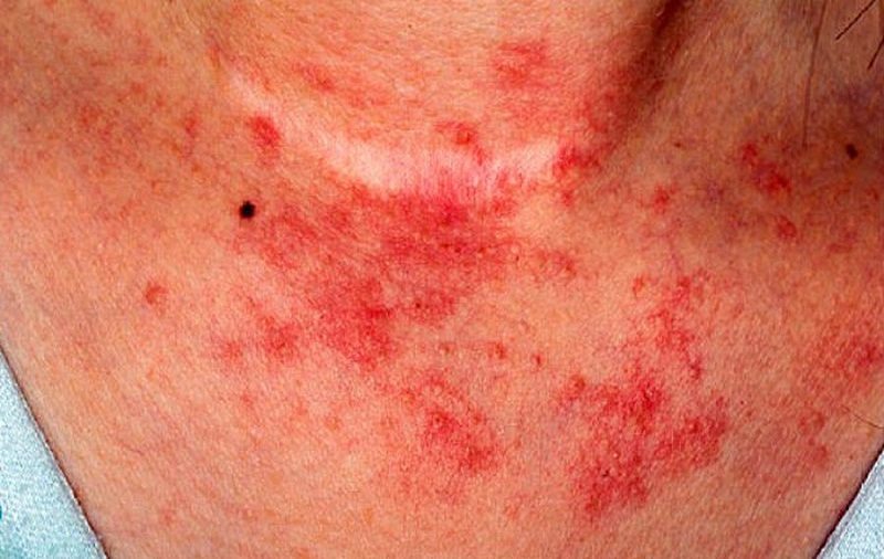 Triệu chứng bệnh eczema ám ảnh nhiều người