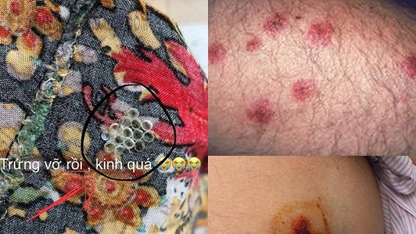 Tiếp xúc với dịch vàng của bọ xít có thể khiến da bị tổn thương, viêm loét