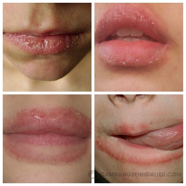 Một số hình ảnh bệnh chàm môi