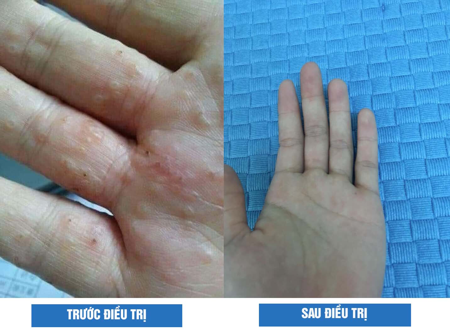 Hình ảnh trước và sau khi điều trị của tôi với bài thuốc Thanh bì Dưỡng can thang từ Trung tâm Thuốc dân tộc