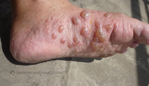 Bài thuốc Đông y trị bệnh tổ đỉa ở lòng bàn chân