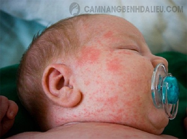 Trẻ sơ sinh là đối tượng rất dễ mắc các bệnh viêm nhiễm về da