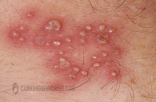 Hình ảnh bệnh eczema