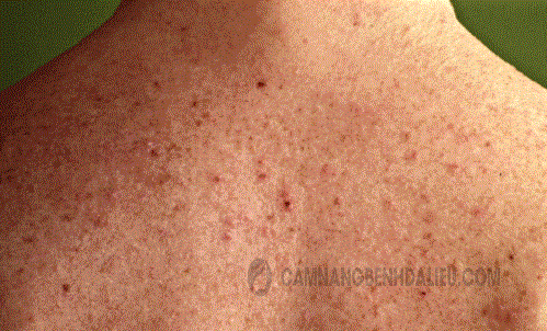Hình ảnh bệnh eczema