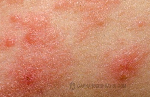 Hình ảnh bệnh eczema trên da