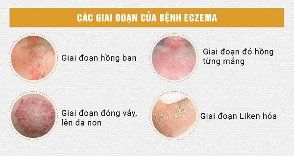 Triệu chứng của bệnh eczema
