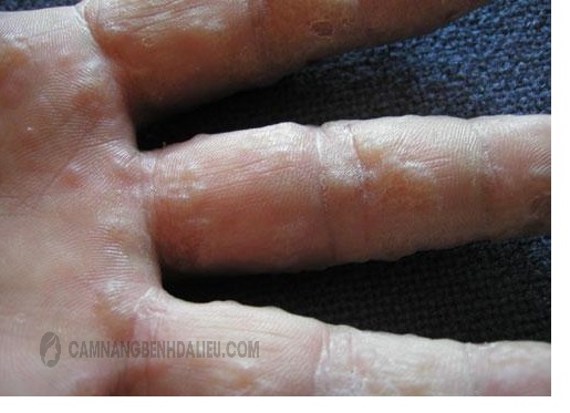 Da tay xuất hiện các mụn nước, triệu chứng của nấm tổ đỉa