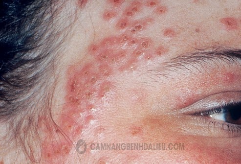 Một số hình ảnh bệnh Eczema