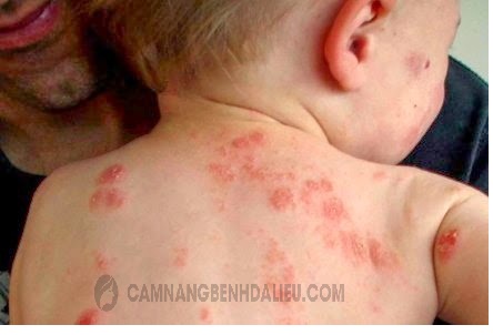 Eczema có di truyền không