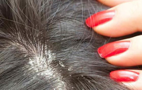 Nấm da đầu gây ra ngứa, gàu và rụng tóc