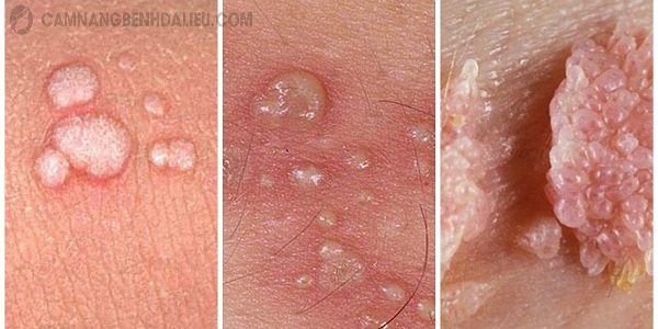 Nam giới nhiễm Herpes gây ra hiện tượng phồng rộp, mụn nước ở da