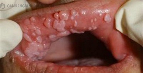 Mụn rộp sinh dục ở miệng làm làm xuất hiện các nốt mụn nước, vết loét