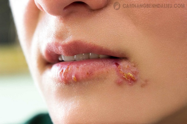 Mụn rộp sinh dục ở miệng do virus herpes gây ra