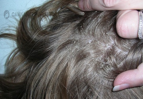 bệnh nấm da đầu