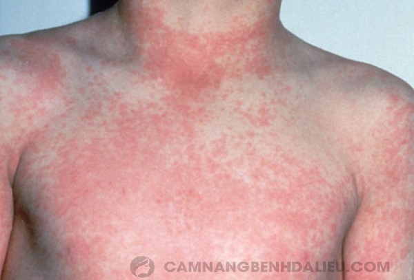 Có nhiều nguyên nhân gây ra tình trạng nổi mẩn đỏ trên da