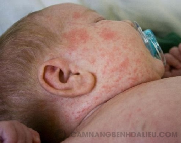 Trẻ sơ sinh bị nổi mẩn đỏ, dị ứng, mề đay là tình trạng bệnh lý về da thường gặp