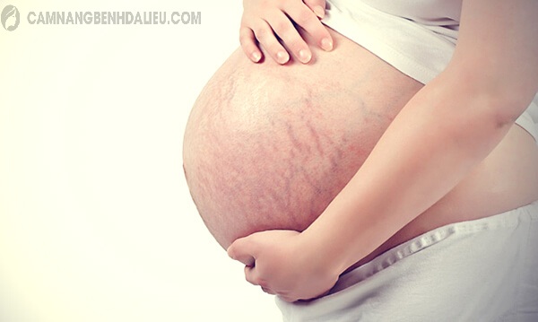 Phụ nữ mang thai dễ bị rạn da bụng do sự phát triển của thai nhi trong bụng
